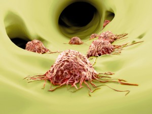 Zirkulierende (wandernde) Krebszellen führen zu Krebs-Metastasen